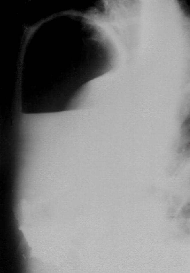 Letokolt/szabad folyadékgyülem Ascites cirrhosis tumor hypoalbuminaemia