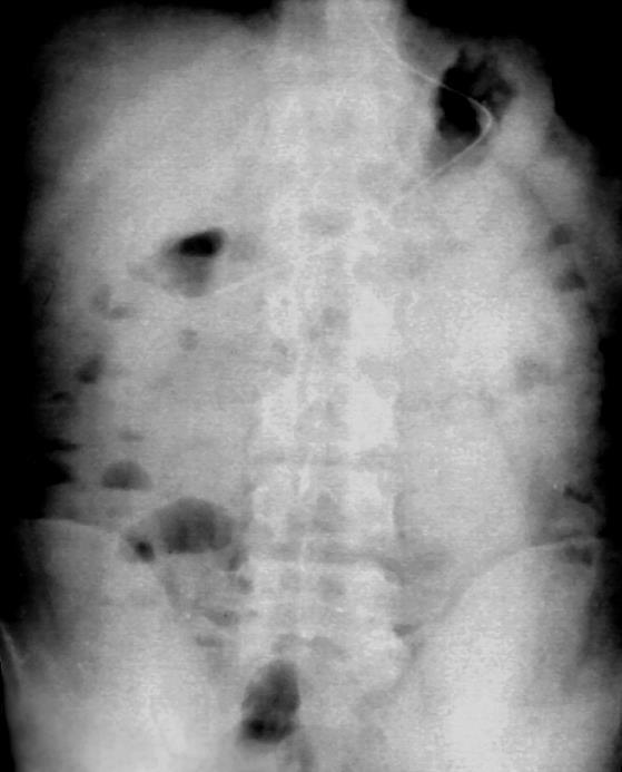 Diffúz/segmentalis gáz/folyadék nívó Paralyticus ileus Diffúz peritonitis gastroenteritis hasi fájdalom egyéb (postoperativ, gógyszer,