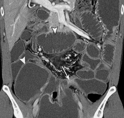 Diffúz/segmentalis gáz/folyadék nívó Obstructio Vékonybél Adhesio Crohn s Neoplasma Hernia