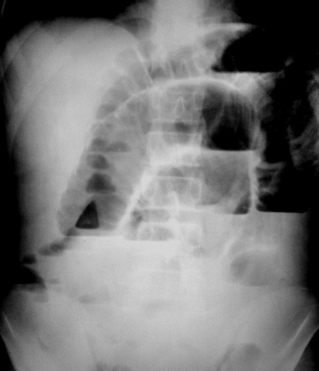 Diffúz/segmentalis gáz/folyadék nívó Obstructio Vékonybél Adhesio Crohn s