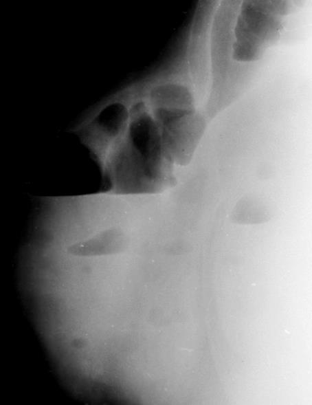 Adhesio Crohn s Neoplasma Hernia