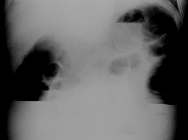 Neoplasma Hernia Irradiatio Vastagbél