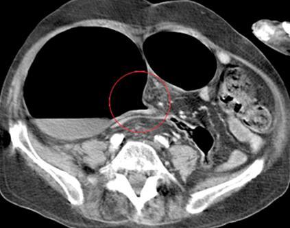 Vastagbél Carcinoma Volvulus