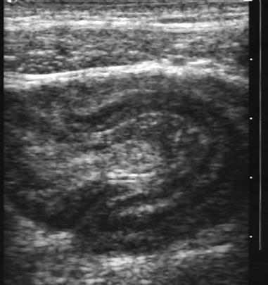 Crohn s Neoplasma