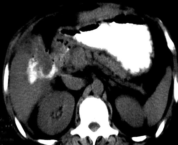 Extraluminalis (aneurysma, tumor, iatrogen,