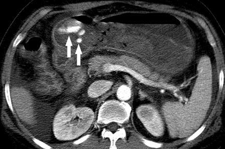 iatrogen, etc) Extraluminalis (aneurysma,