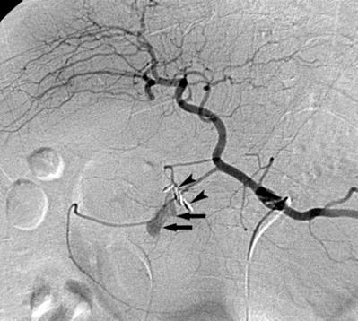 (tumor, iatrogen, etc) arteriographia: 0.