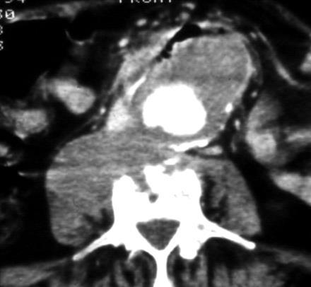 Extravasatio Perforatio Vérzés Endoluminalis