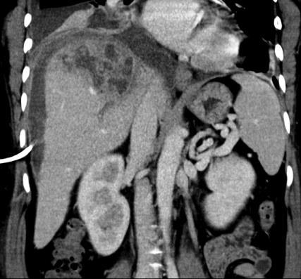 Extravasatio Perforatio Vérzés Endoluminalis