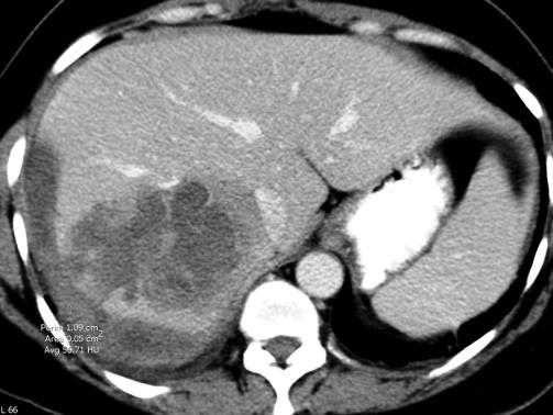 Extraluminalis (aneurysma, tumor, iatrogen,