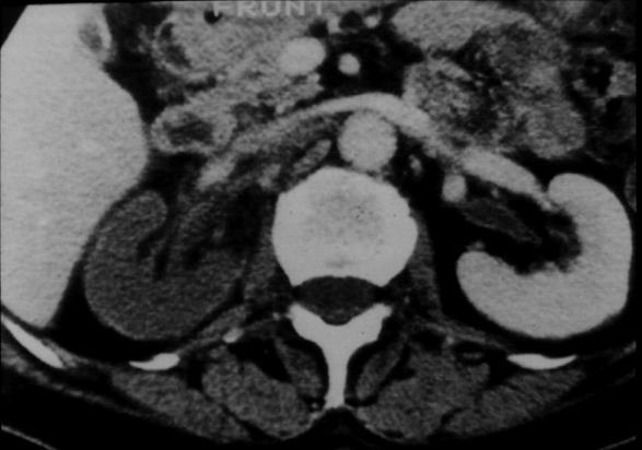 Pathologiás keringés Arteriás thromboembolia (MI, rheumás szívbetegség,