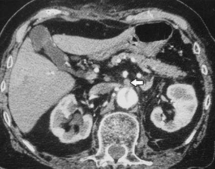 ) arteriosclerosis dissectio szívelégtelenség egyéb (iatrogen, idiopathiás,