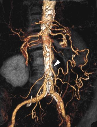 Pathologiás keringés Arteriás thromboembolia (MI, rheumás szívbetegség,