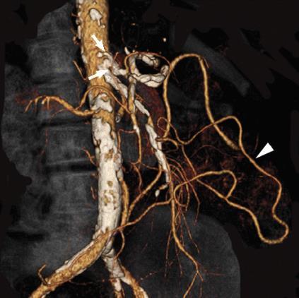 ) arteriosclerosis dissectio szívelégtelenség egyéb (iatrogen, idiopathiás,