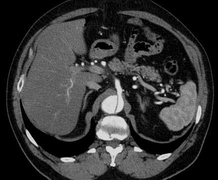 Pathologiás keringés Arteriás thromboembolia (MI,