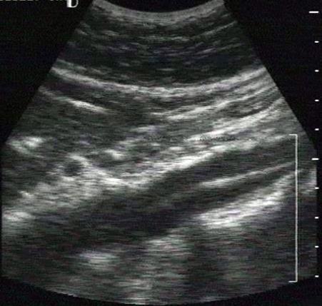 ) arteriosclerosis dissectio szívelégtelenség egyéb