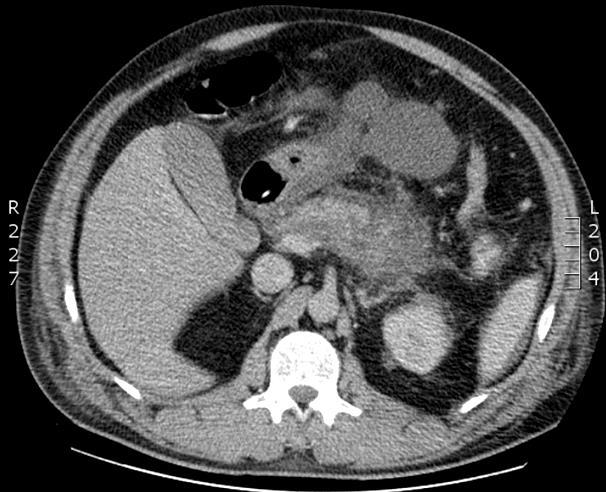 Pathologiás keringés Arteriás thromboembolia (MI, rheumás szívbetegség, pitvarfibrillatio, etc.