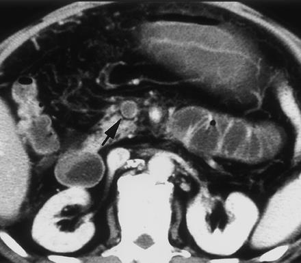 Pathologiás keringés Arteriás thromboembolia (MI, rheumás szívbetegség, pitvarfibrillatio, etc.