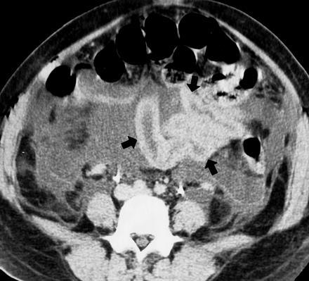 Vastag fal Infarctus, ischaemia Intramuralis haematoma Gyulladás epiploicus