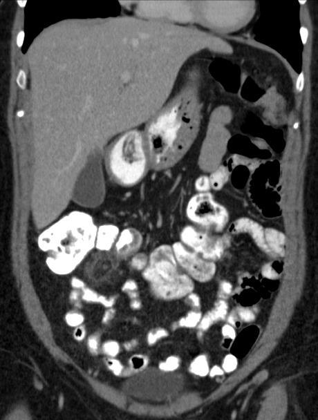 Vastag fal Infarctus, ischaemia Intramuralis haematoma Gyulladás epiploicus