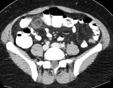 (neutropeniás colitis) pseudomembranosus colitis (clostridium difficile) más (TBC,