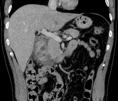 sigmoiditis typhlitis (neutropeniás colitis) pseudomembranosus colitis