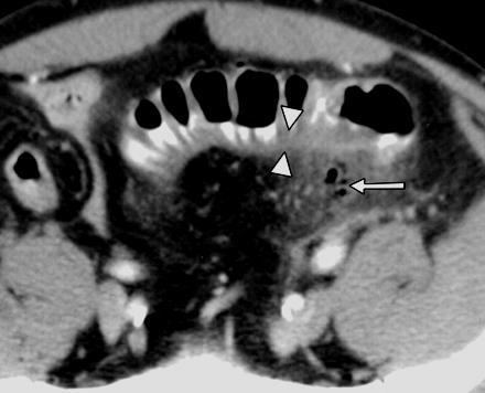 Vastag fal Infarctus, ischaemia Intramuralis haematoma Gyulladás epiploicus appendagitis Groove pancreatitis Infectio appendicitis sigmoiditis typhlitis