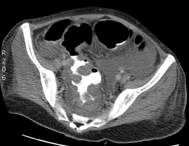 Vastag fal Infarctus, ischaemia Intramuralis haematoma Gyulladás