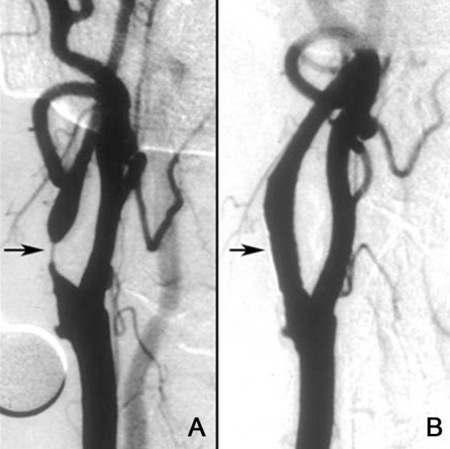 2. ábra. A, Jobb oldali szignifikáns arteria carotis stenosis; B, Beavatkozás (stent beültetés) utáni állapot (Forrás: White, 2014) I.1.3.