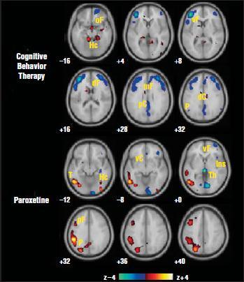 CBT / paroxetin hatása depresszióban -14+13 depressziós beteg - Standard CBT (15-20 ülés) vagy paroxetin -A tüneti javulás szignifikáns funkcióbeli változásokkal járt fmri-n egyes agyterületeken -- A