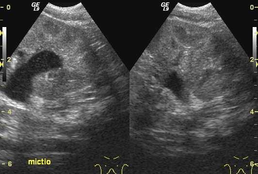 AMI ULTRAHANGGAL BIZONYTALAN: A vese mőködése Az obstructio organikus vagy functionalis Reflux Ectopiás ureter Kettıs