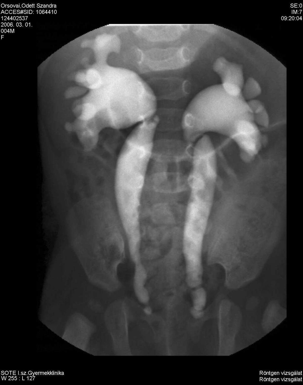 VESICOURETERALIS REFLUX MICTIOS CYSTORETHROGRAPHIA - Képerısitı mellett,