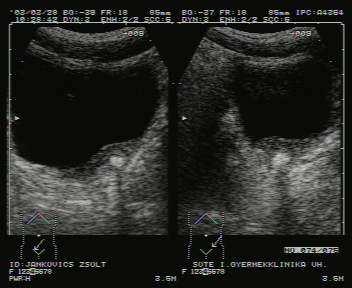 URETERKİ, HÓLYAGKİ