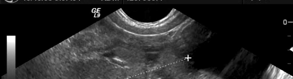 Agenesis Hypoplasia