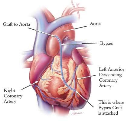 KEZELÉS REVASCULARISATIO CABG műtét - főtörzs (arteria coronaria sinistra kezdeti szakasz) szignifikáns szűkület - angina és háromérbetegség, különösen bal kamra dysfunctio esetén, - angina,