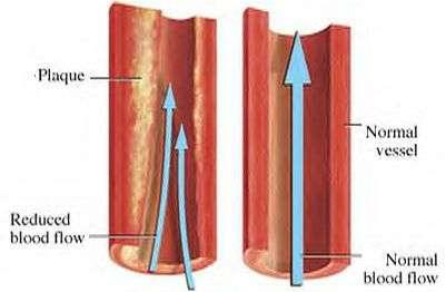 Vasospasticus angina C/ Fizikai 1. Catheter indukált 2. PTCA (PCI) 3. Laser (különösen NdYAG és Argon) 4. Atherectomia 5.