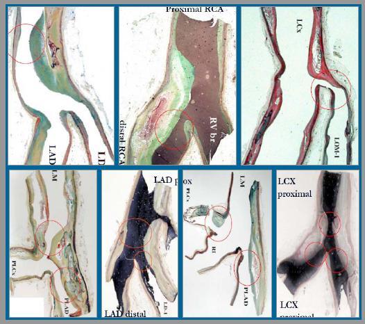 Az atherosclerosis progressziója a Az atherosclerosis gyakran érinti a bifurkációkat A szűkület az alacsony nyírófeszültségű területeken kezdődik