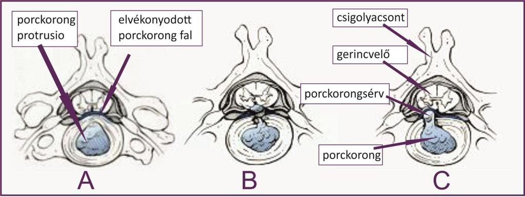 A. A porckorongfal előboltosulása B. Középvonalas sérvesedés C. Oldalsó sérvesedés (2. ábra) Melyek a betegség alapvető tünetei?