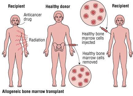 Őssejt-transzplantáció A károsodott imunrendszer újra-építése Allogén az őssejtet más személyből (donorból) nyerik Autológ saját sejt a betegből gyűjtik, kemoterápia előtt Vérből