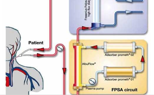 MARS (Molecular Adsorbents Recyrculating Systems) és Prometheus (műmáj kezelés): hatékony máj detoxikáló kezelések Prometheus (Frakcionált plazma szeparációs adszorpció: FPSA és dialysis ):