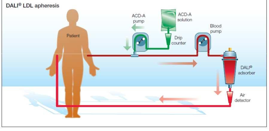 LDL aferezis (DALI) DALI = Direct Adsorption of Lipoproteins Plazma szeparáció nélkül,