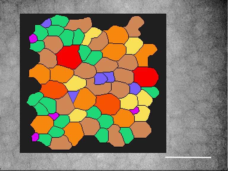 endothel sejtszámon kívül megkaphatjuk az endothelsejtek nagyság szerinti eloszlási görbéjét is, az átlagos sejtnagyságot, és még számos statisztikai paramétert is [93]. 12. ábra.