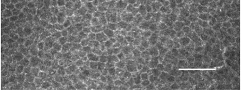 15µm átmérőjű, erősen reflektív, elágazódó struktúrák képében ábrázolódtak az intermedier és basalis epithelsejtek között, a Bowman rétegben és a subepithelialis idegplexusban, a felszíntől átlagosan