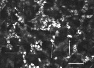 a stroma elülső részében is ovoid, erősen reflektív képleteket észleltünk, melyek átmérője 10-25µm között mozgott (33. ábra)