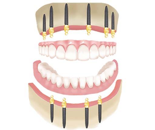 11 Hajdú József Melyiket válasszam? Implantátum választás dilemmája AJÁNLÁS: Jogos a kérdés felvetés, különösen, ha valaki most kezdi az implantológusi tevékenységét.