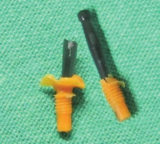 BIONIKA módszer 27 BIONIKA módszer: út az ismeretlenhez Ismeretlen implantátumok megismerési technikája, avagy hogyan készítsünk felépítményeket ismeretlen implantátumokra?