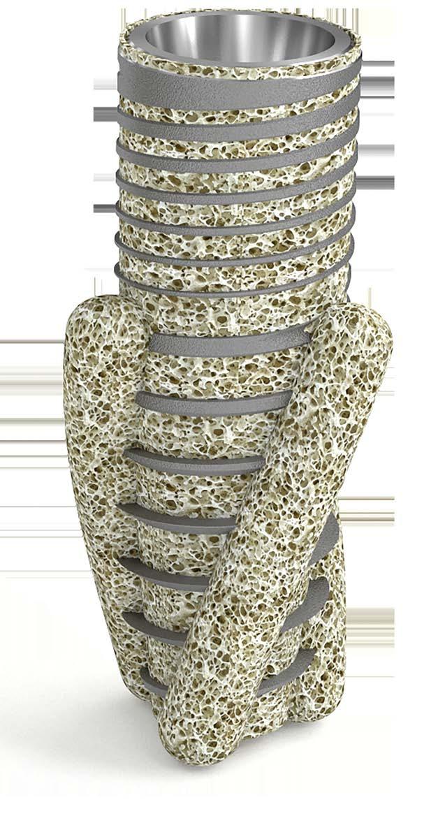 BIOKOSÁR 31 Hipotézis vagy realitás? 4. Ábra: Biokosár a beültetett implantátummal Igazolásra vár.