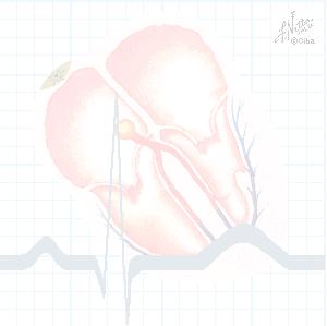 Bal pitvari abnormalitások (P mitrale) Bevezetés azekg analízisbe V.