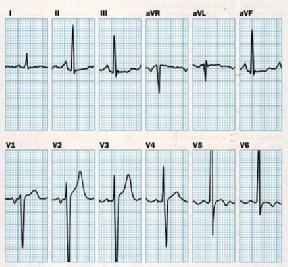 defektus miatt Cardiomyopathia Súlyos aorta billentyű betegség, mitral billentyű betegséggel vagy nélküle, + pulmonáris hypertenzió 11 P hullám nagysága 2.75 sec, ideje0.