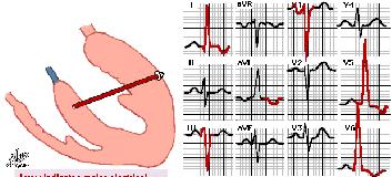 P hullámnormális, R hullám magas ést vektora normális, QRS-T szög normális Bal kamraihypertrófia(közepesen súlyos aorta sztenózis) 17 18 P